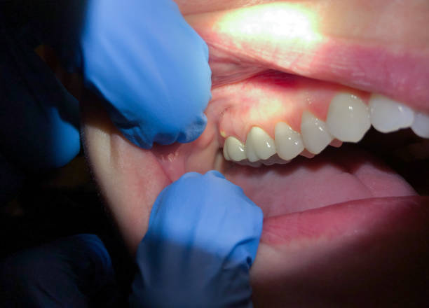 Best Chipped Tooth Repair Near Me  in Rockport, IN